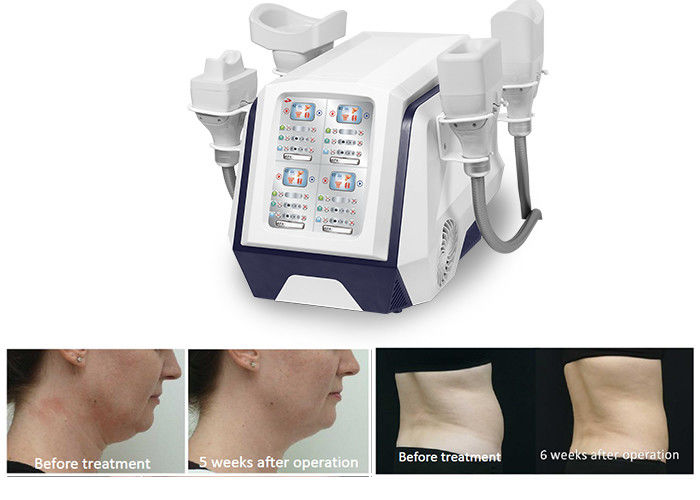 Máy giảm béo cơ thể cầm tay 360 Cryolipolysis 1000W để giảm cân đốt cháy chất béo