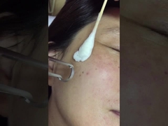 Pico Laser Treatment on Face